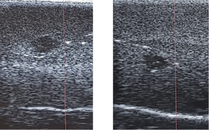 Símiles de tumores insertos en un símil de tejido fibroglandular